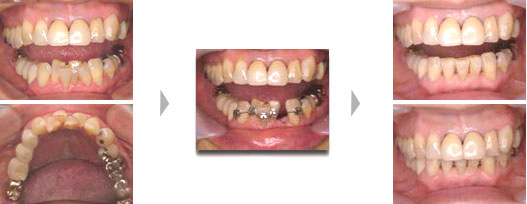 下顎前歯抜歯症例１