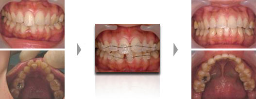 下顎前歯抜歯症例２